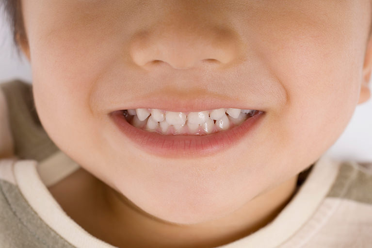 子どもの歯並びが気になります。いつ頃から矯正治療を検討するべきですか?